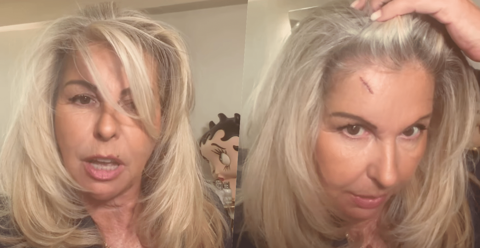 Affaire conclue : Caroline Margeridon fait une lourde chut sur un escalier et se retrouve avec une énorme entaille au visage